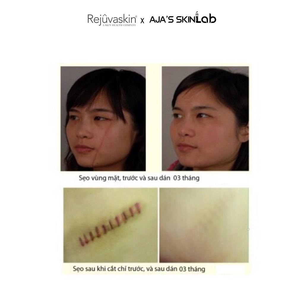 Miếng dán ngăn ngừa, nén sẹo lồi Scar FX 3.75x7.5cm REJUVASKIN