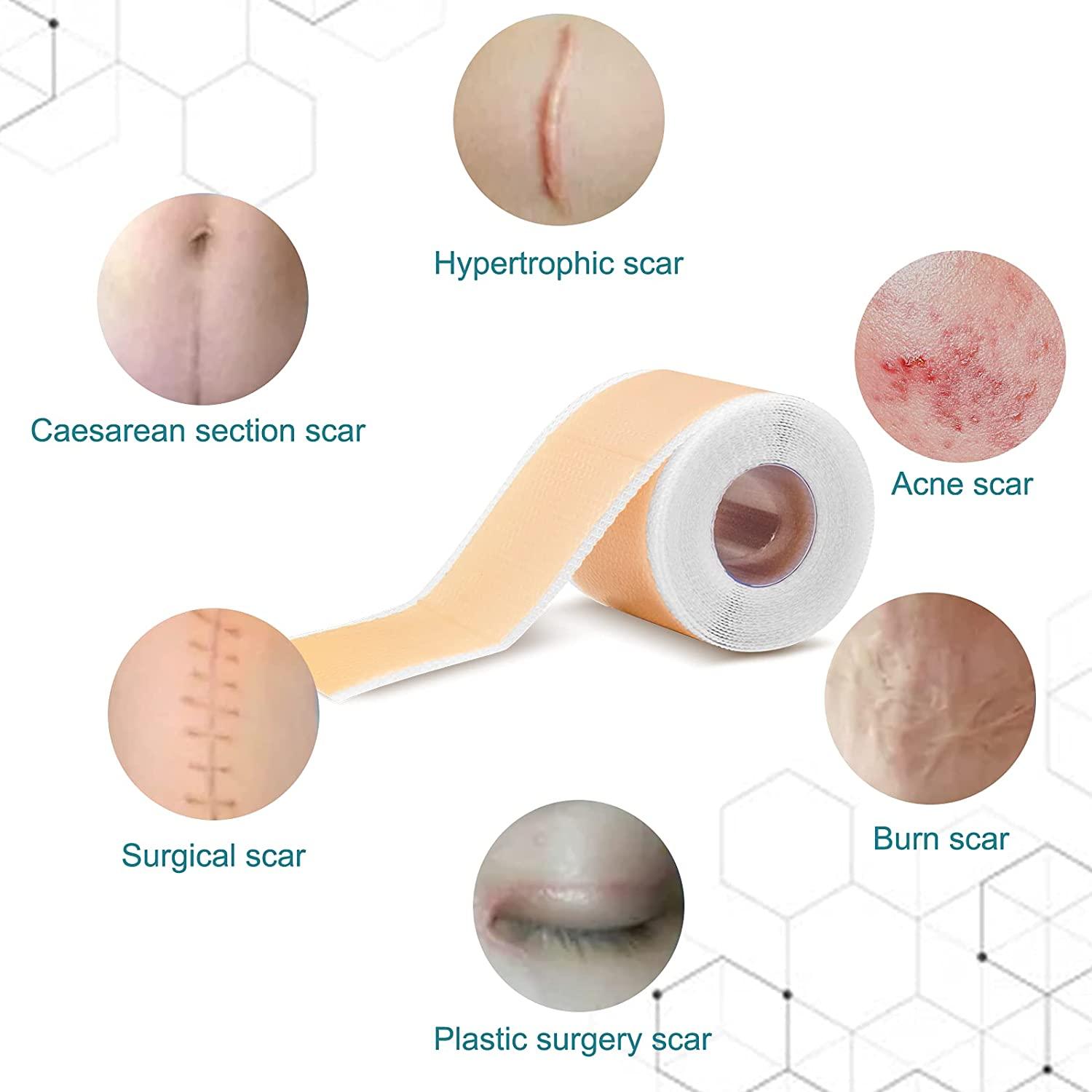 Silicone Scar Dressing để lá từ vết sẹo silicone cho sinh mổ, phẫu thuật, bỏng, sẹo, sẹo do mụn trứng cá