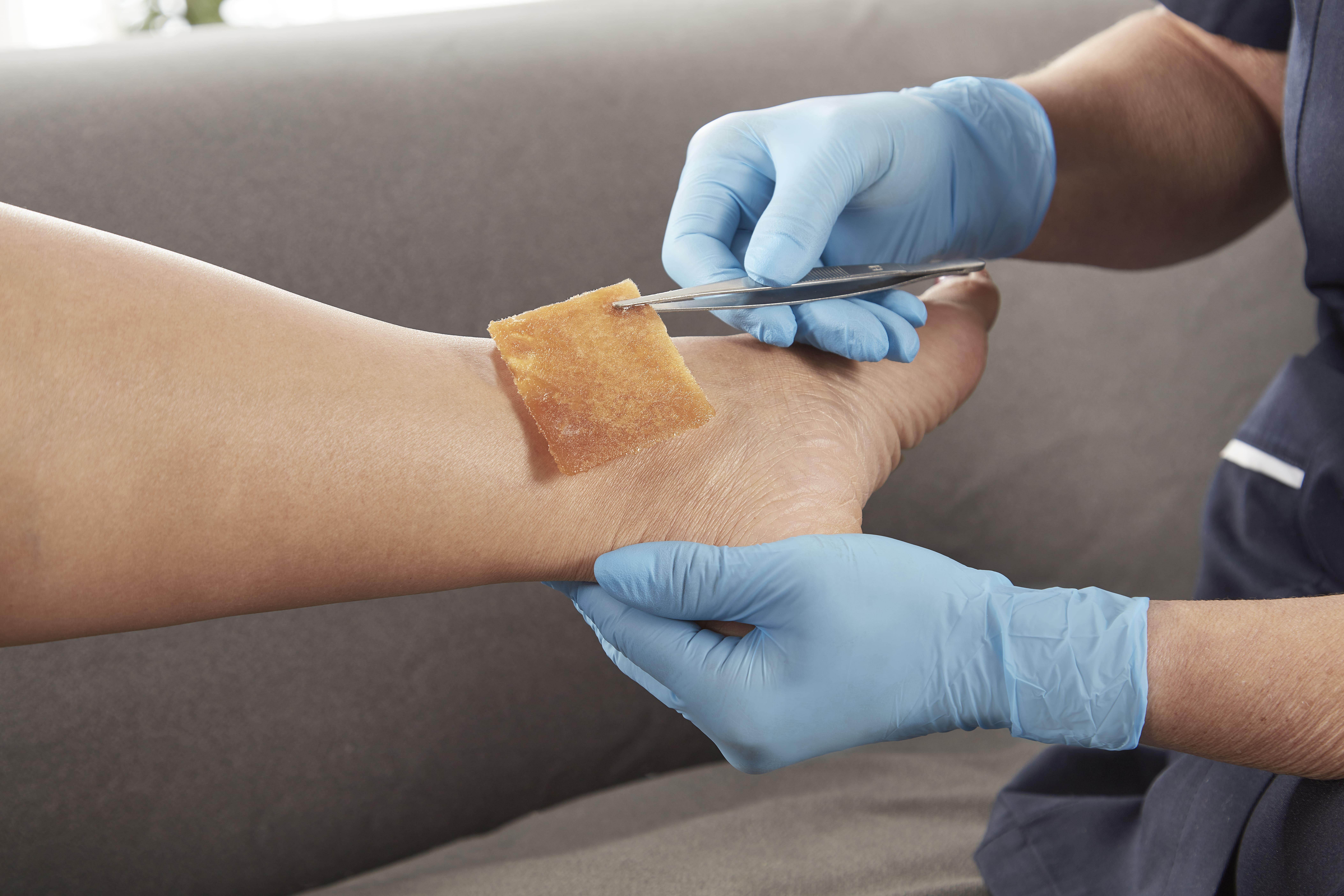 Gạc tẩm mật ong Manuka chăm sóc vết thương nhiễm khuẩn - Algivon