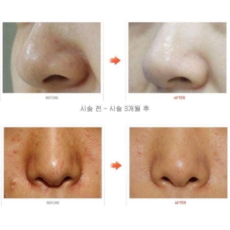 Máy Chăm Sóc Da, Giúp Giảm Thâm Nám, Mờ Tàn Nhang, Trẻ Hóa Da AQUA PEELING ABELUNA M200, Nhập Hàn, BH 12 THÁNG