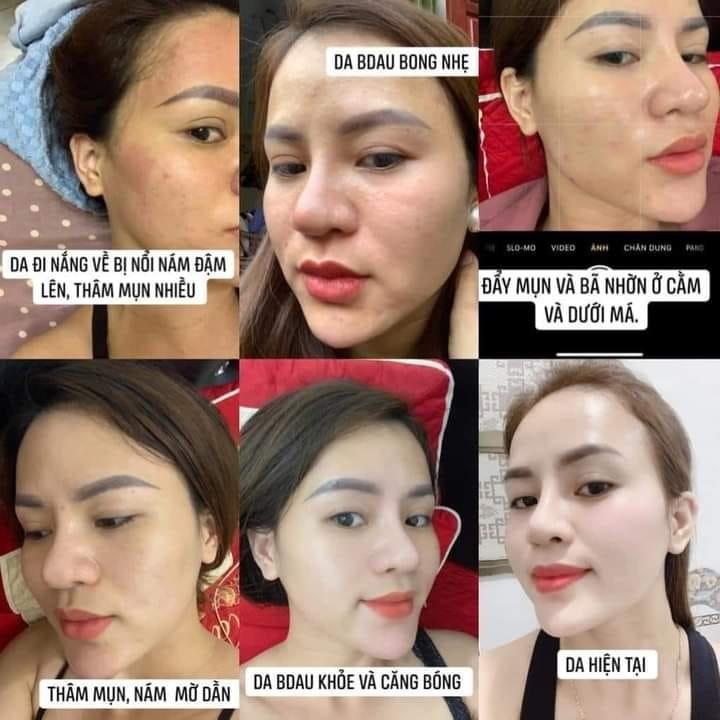 Combo Huyền Phi Cosmetics phục hồi da