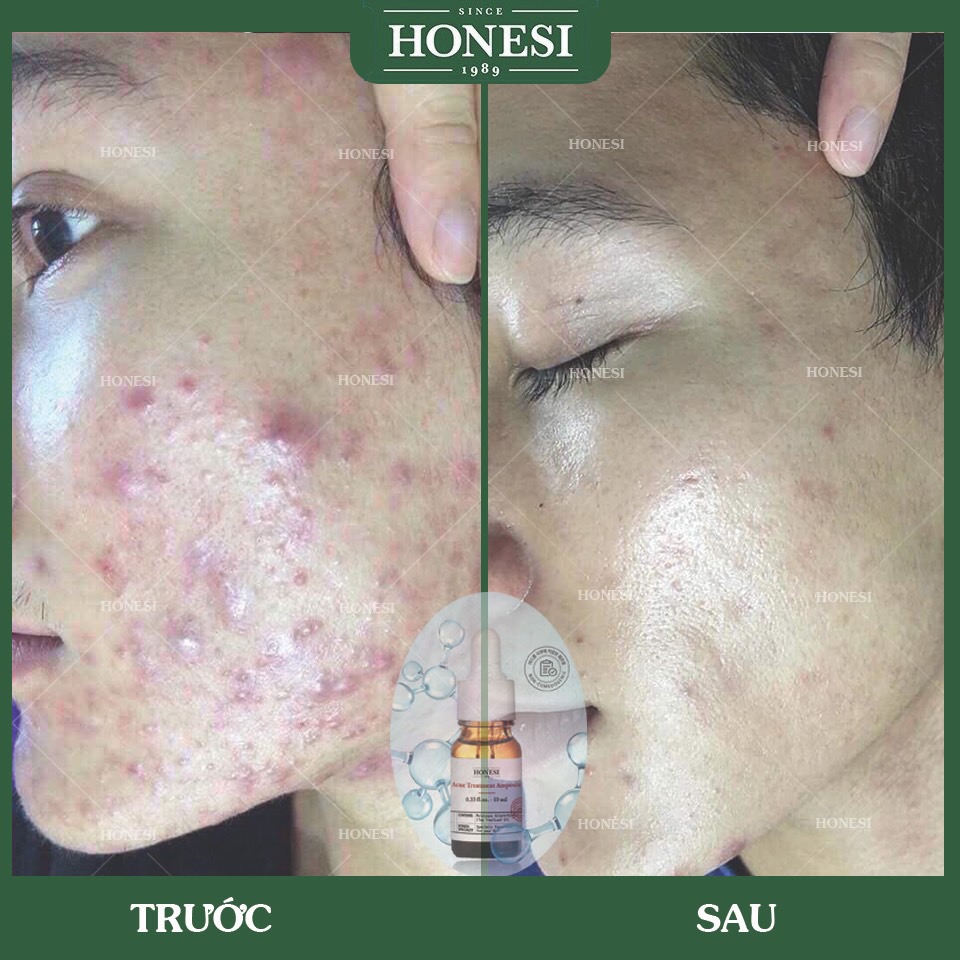 Sét Serum Giảm Mụn Nhanh Lành Tính HONESI Acne Treatment Ampoule (10ml x 5 lọ) - Hàn Quốc