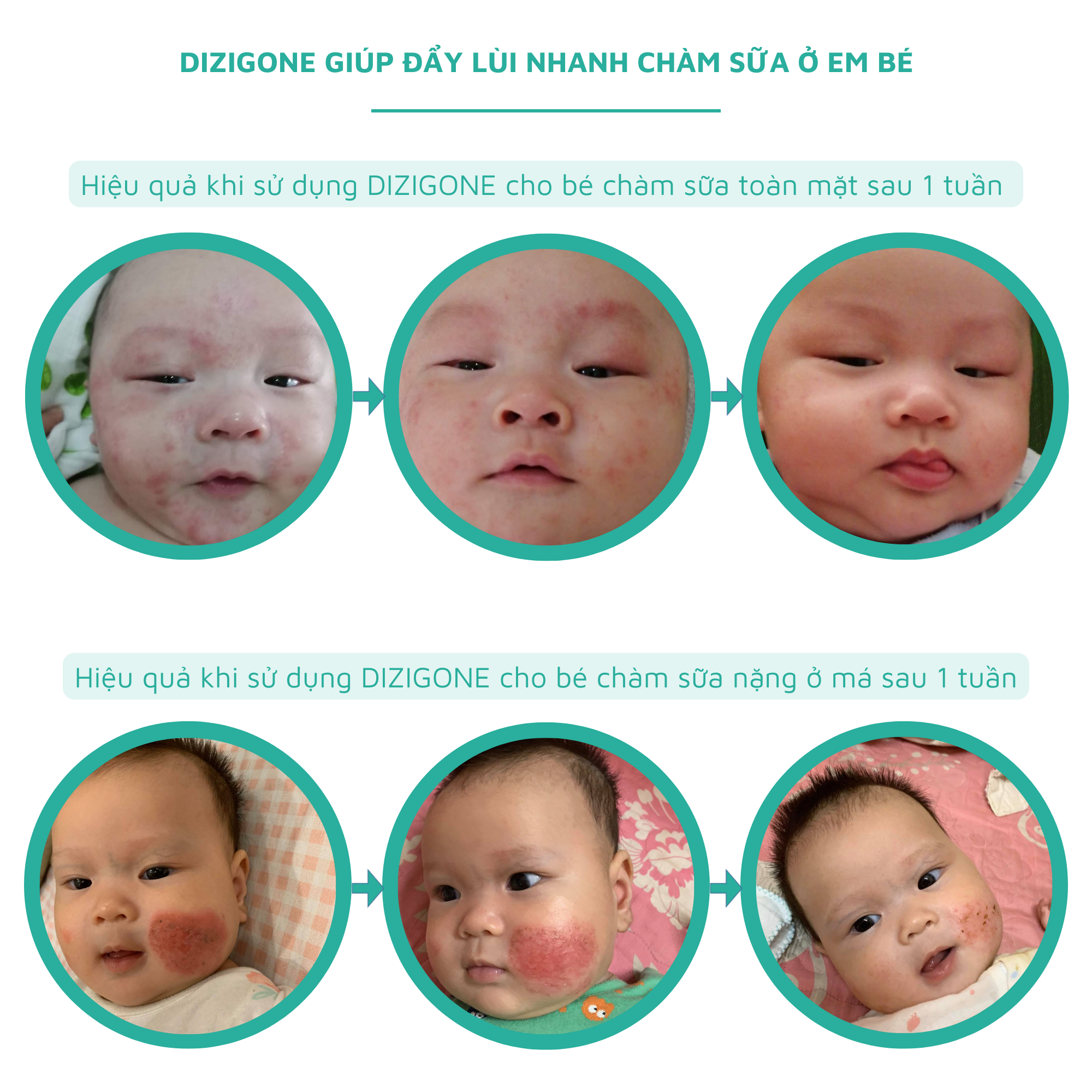 Xịt kháng khuẩn DIZIGONE chăm sóc tổn thương lành nhanh, không đau xót, tái tạo da, ngăn ngừa sẹo