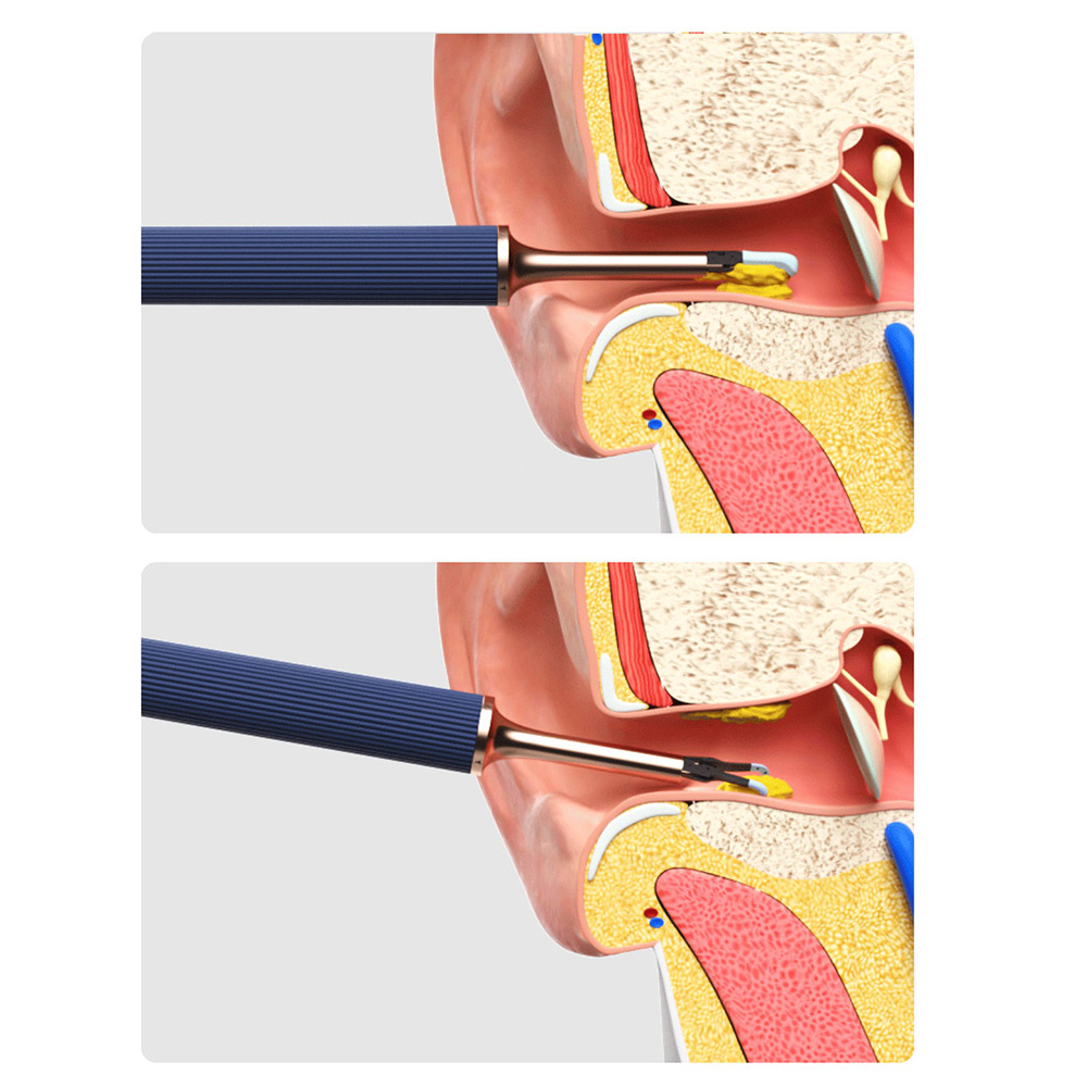 Thiết Bị Lấy Ráy Tai Bebird Smart Visual Earpick Stick Note3 1000W High-precision Endoscope Dual-use Earpick and Tweezers Wireless In-Ear