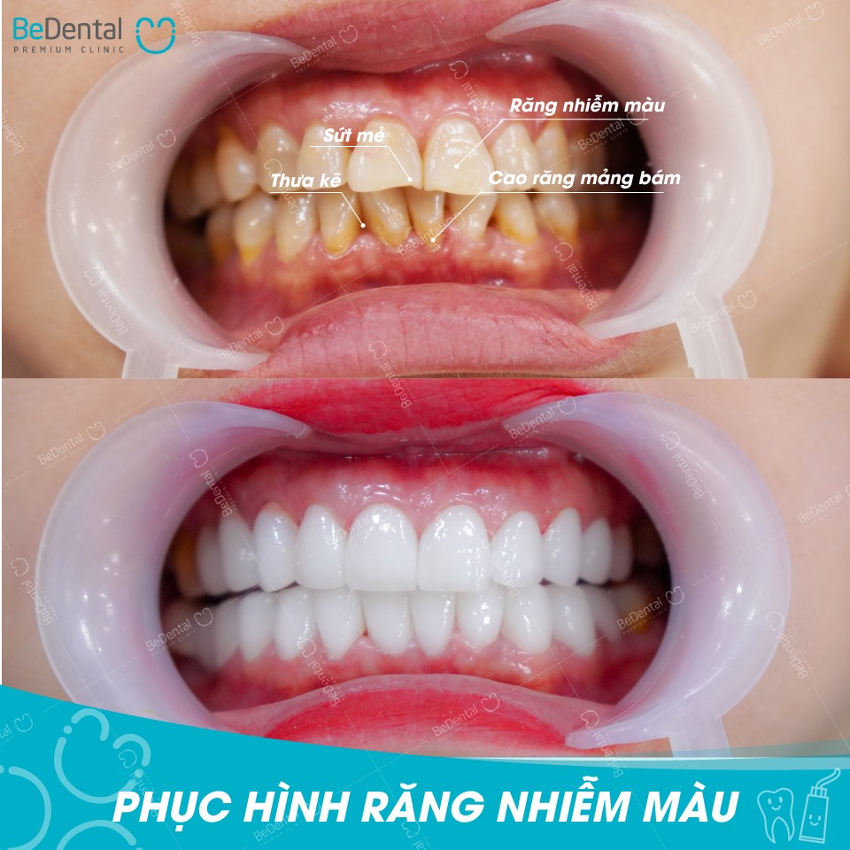 Lấy Cao Răng Và Đánh Bóng Công Nghệ Siêu Âm Mới - Nha khoa BeDental