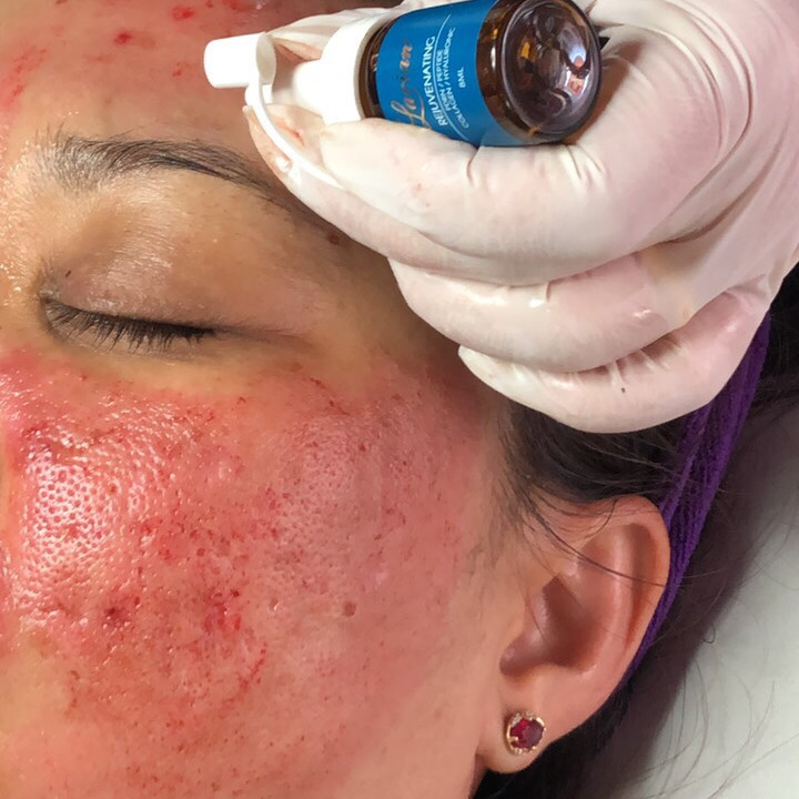 Tế bào gốc siêu tăng trưởng làm đầy sẹo lõm, căng bóng da Rejuvenating Ampoule