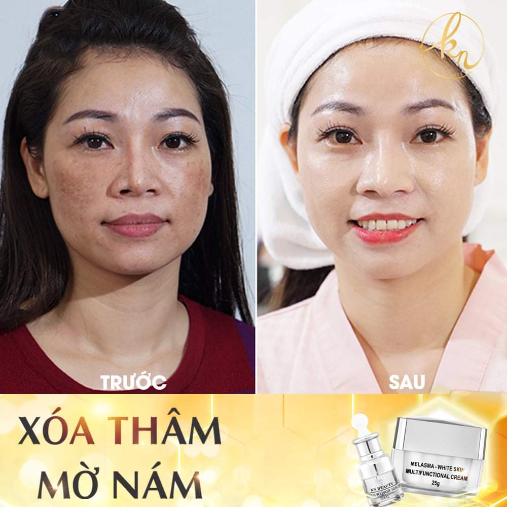 Bộ 3 sản phẩm Trắng Da Ngừa Nám KN Beauty chuyên sâu:Kem dưỡng 25g + Serum 30ml+ Tẩy tế bào chết 120ml