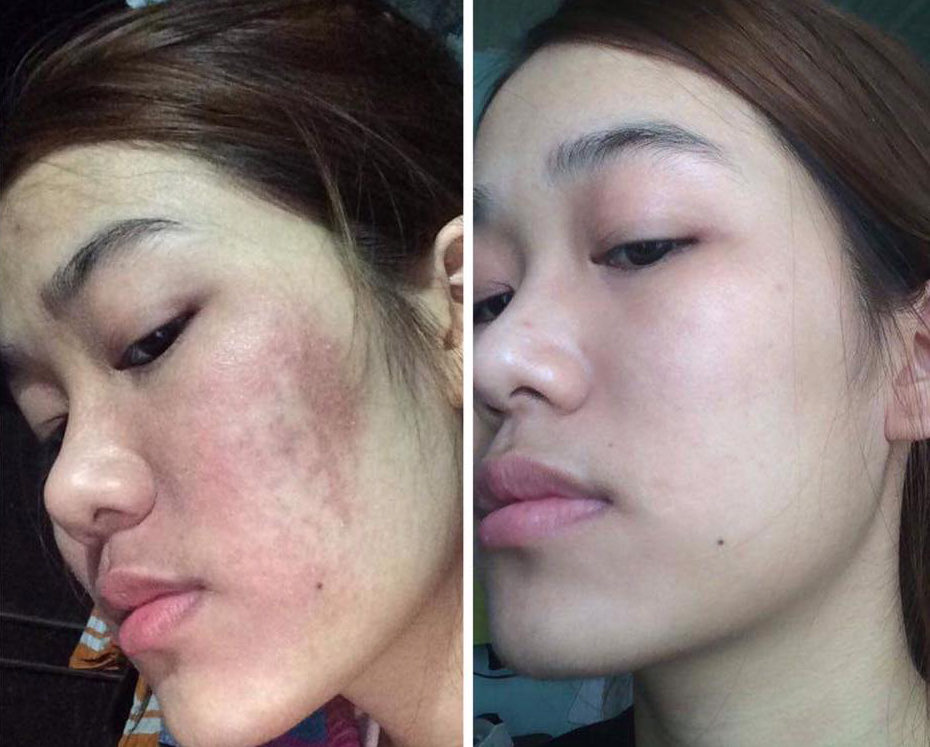 Serum ngừa mụn thâm sẹo rỗ An Dược Sơn 50ml & Bột rửa mặt an dược sơn