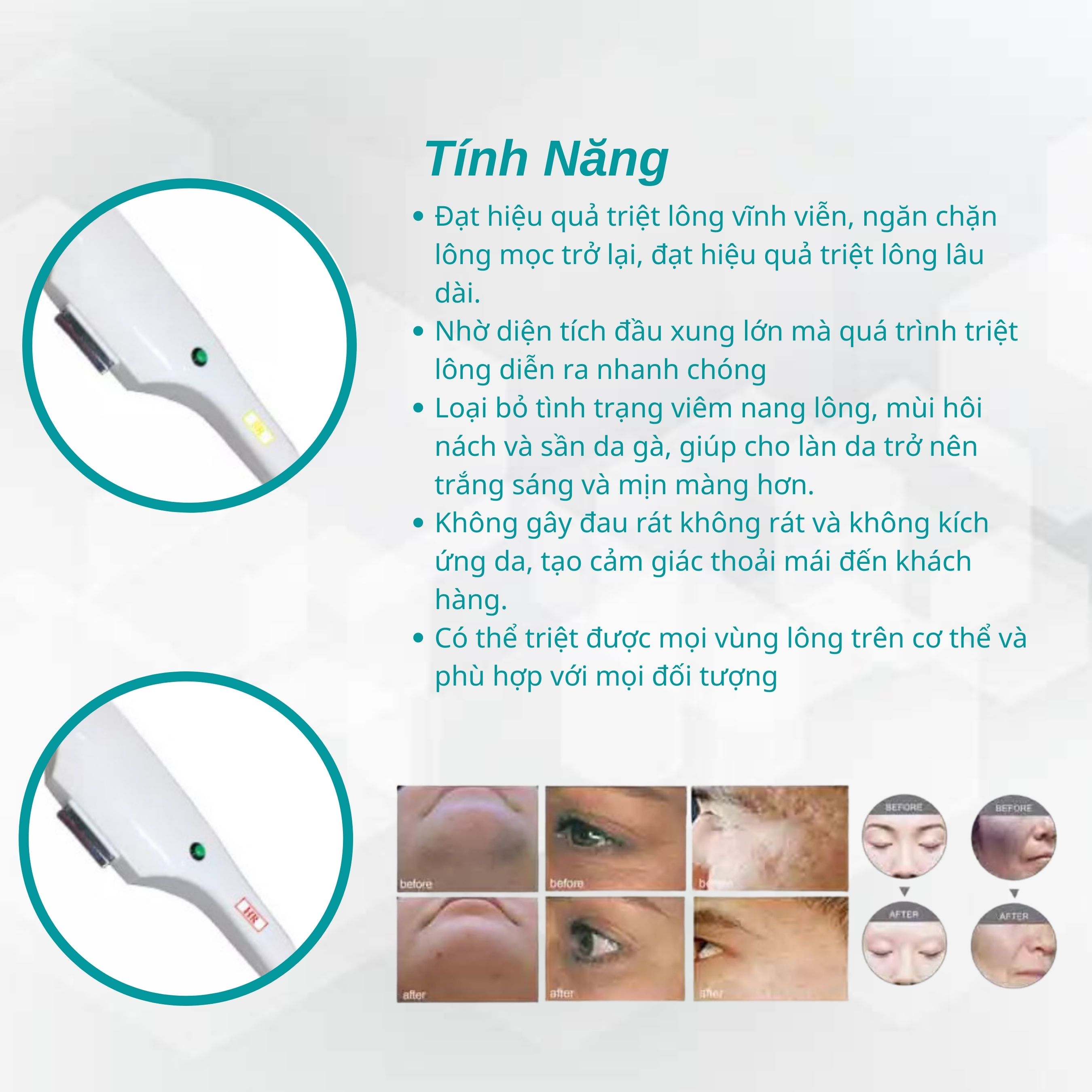 Máy triệt lông công nghệ IPL - SHR VE2000