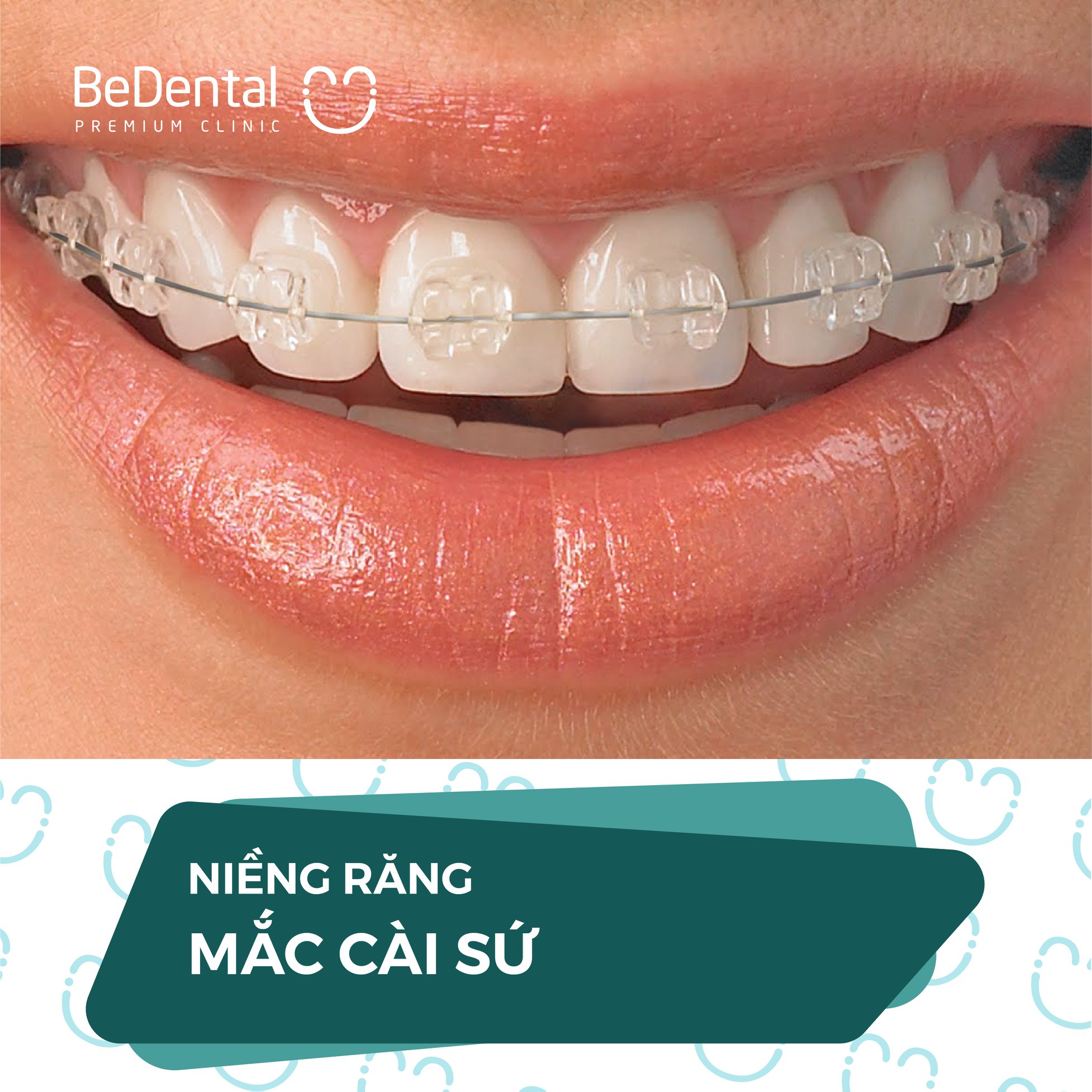 Voucher Niềng răng - Nha khoa BeDental - 5 chi nhánh