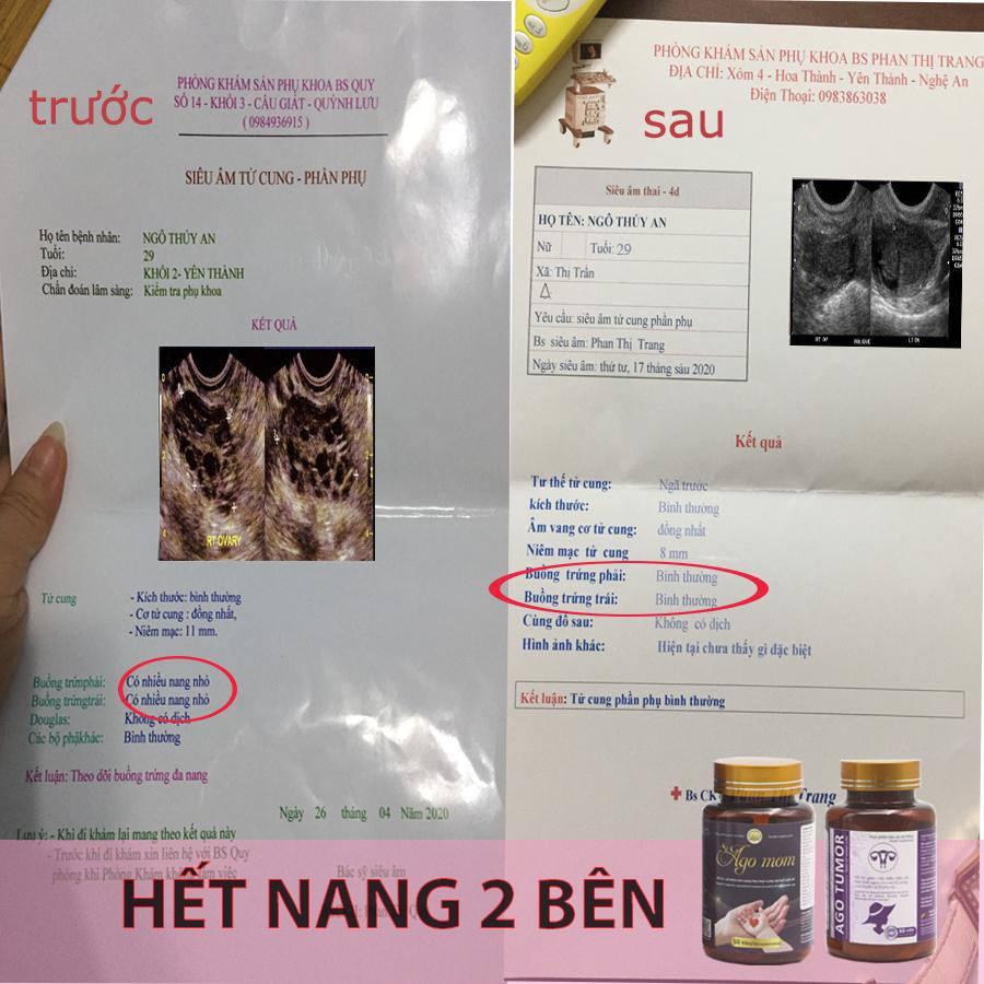 Ago Tumor tiêu u xơ tử cung u nang, đa nang buồng trứng, viêm tắc vòi trứng an toàn không phải mổ không tái lại 50 viên