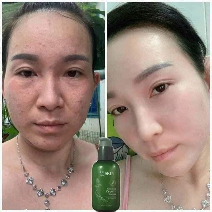 Serum thay da nhân sâm Mqskin tái tạo da nhân sâm giúp giảm trắng da, hồng da, thâm nám, tàn nhang và giảm mụn
