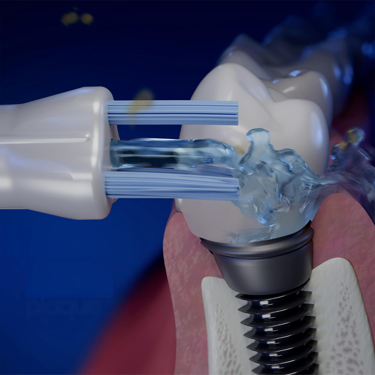 Đầu tăm nước h2ofloss Plaque Seeker – tìm và làm sạch mảng bám, chỉ dành cho máy hiệu h2ofloss, không sử dụng được cho hiệu khác