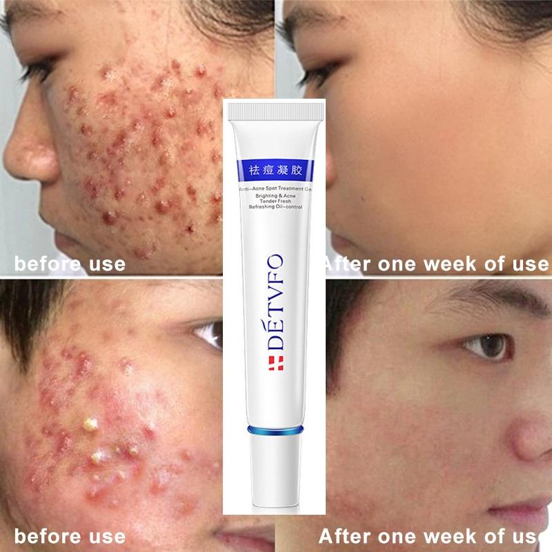 Kem Hết Mụn Loại Bỏ Mụn và Vết Thâm Hoàn Toàn, Thu Nhỏ Lỗ Chân Lông, Kiểm Soát Dầu, Dưỡng ẩm và Nuôi Dưỡng Da Ca