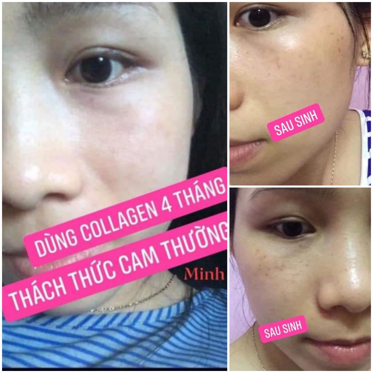 COMBO 3 GÓI PIZKIE  COLLAGEN PEPTIDE CÁ HỒI NHẬT BẢN - HỖ TRỢ TĂNG ĐÀN HỒI CHO DA, GIÚP HẠN CHẾ QUÁ TRÌNH LÃO HÓA DA, GIẢM NẾP NHĂN, GIÚP DƯỠNG ẨM, NGĂN NGỪA RỤNG TÓC (TẶNG KÈM HỘP SỮA NGHỆ HERA COLLAGEN 500GR) 