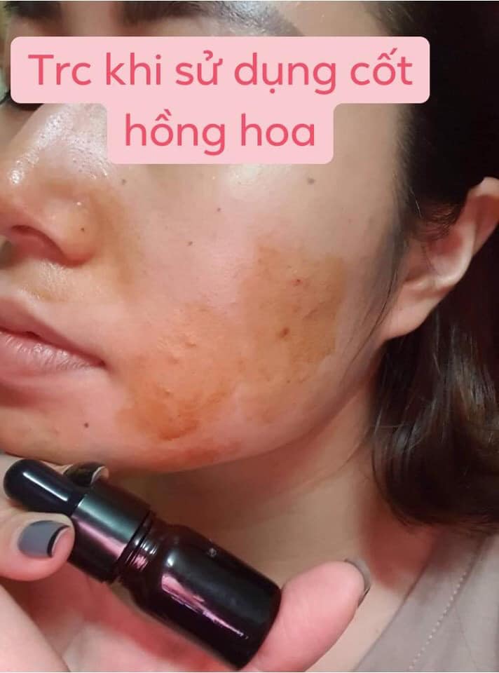 Kem giảm mụn, thâm cốt hồng hoa Rova (combo 2 lọ)