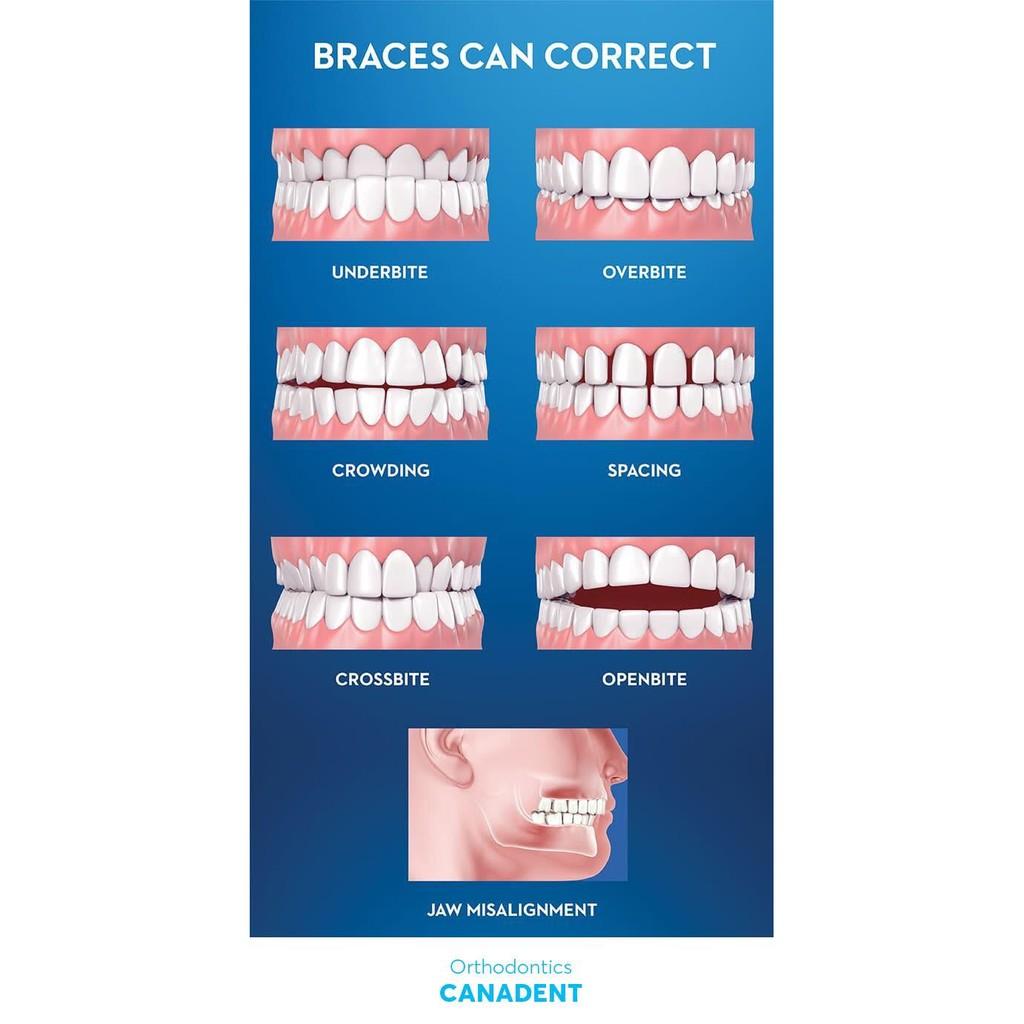 BỘ 3 NIỀNG RĂNG SILICON CANADENT ALIGNMENT.