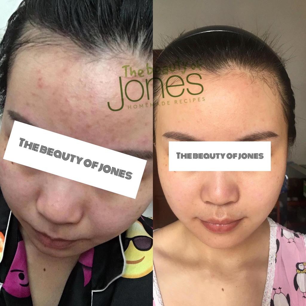 Sample Kem ngừa mụn tràm trà The Beauty of Jones 5gr