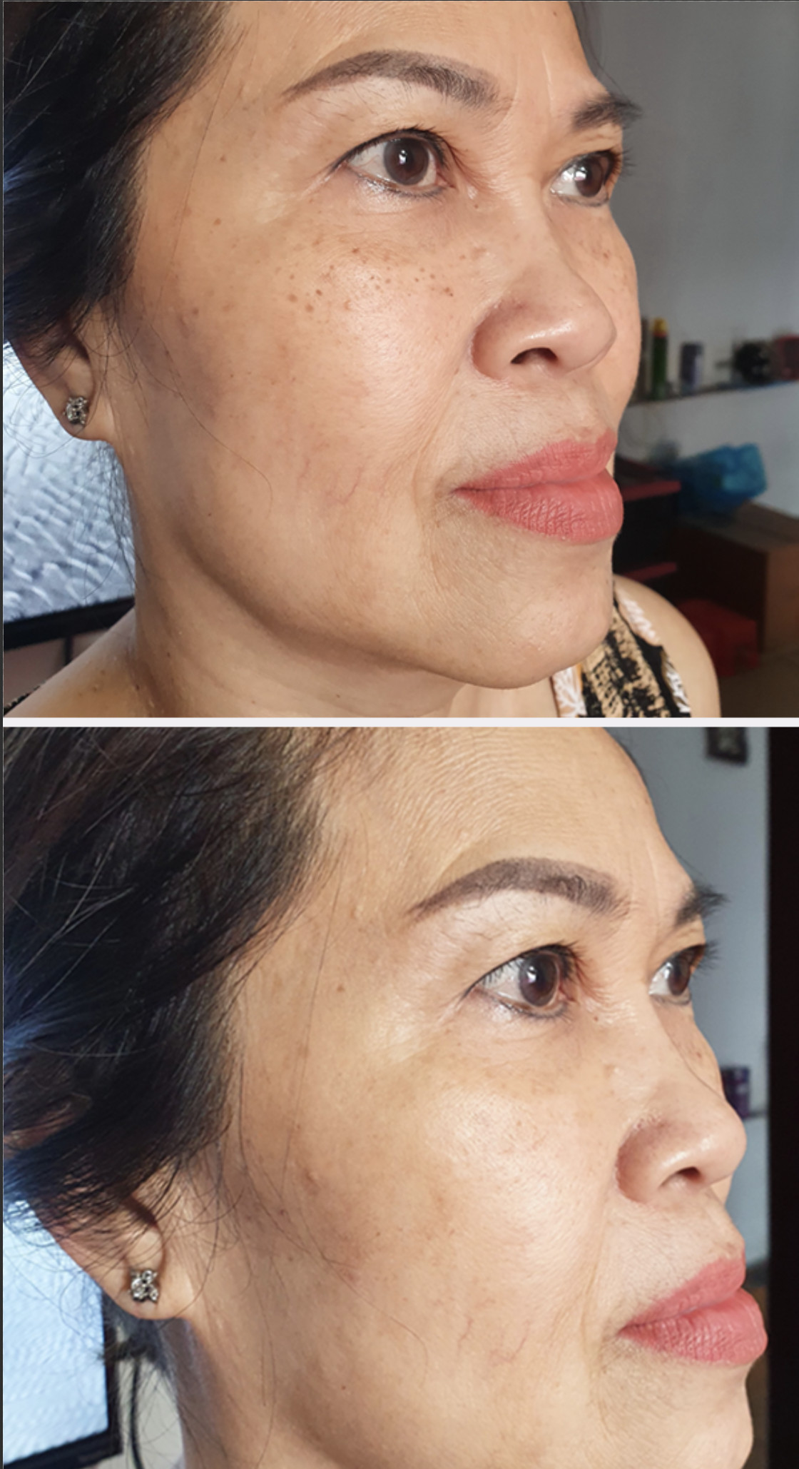 Kem Dưỡng Mờ Nám Chuyên Sâu Angel's Liquid Tranexamic Mela Cream