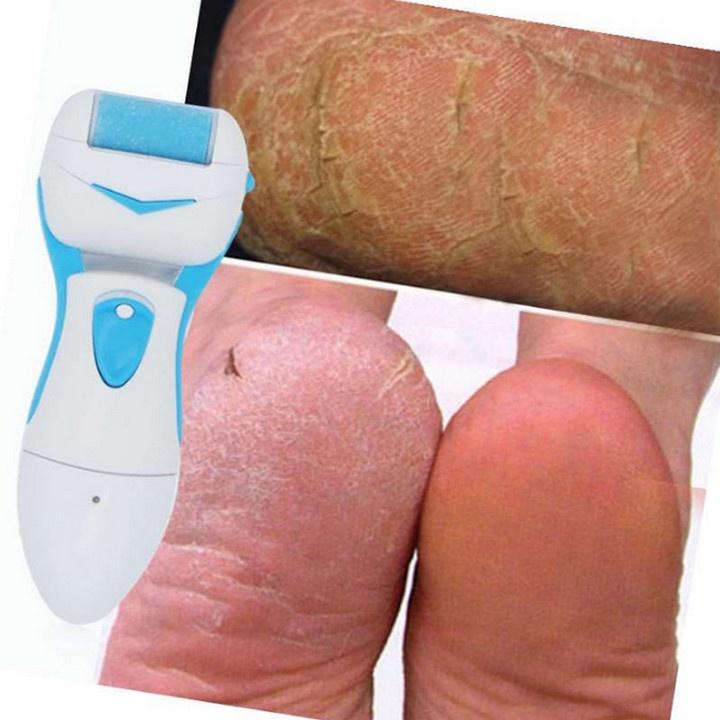 Máy Tẩy Tế Bào Chết Cá Nhân Wet&Dry Callous