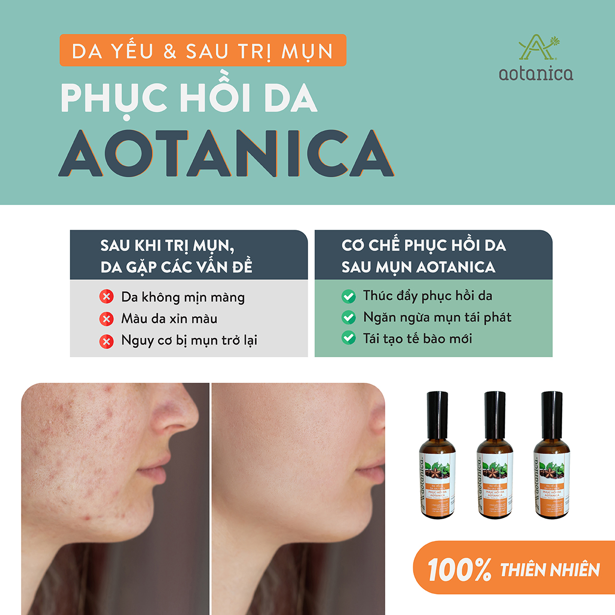 Dầu phục hồi da yếu & sau mụn Aotanica 20ml