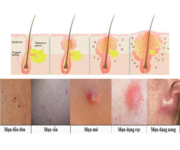 Thảo dược bôi nấm ngứa, tổ đỉa, hắc lào, lang ben, vảy nến, á sừng, zona các vấn đề về da_1 hộp 20 gói