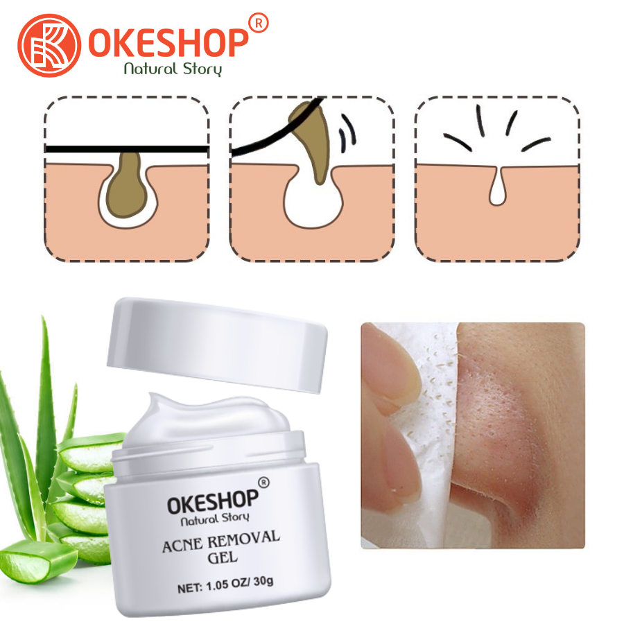 Gel Lột Mụn OKESHOP 30ml - Giải Pháp Loại Bỏ Mụn Đầu Đen - Mụn Cám - Bạ Nhờn - Làm Sạch Sâu Và Thu Nhỏ Lỗ Chân Lông