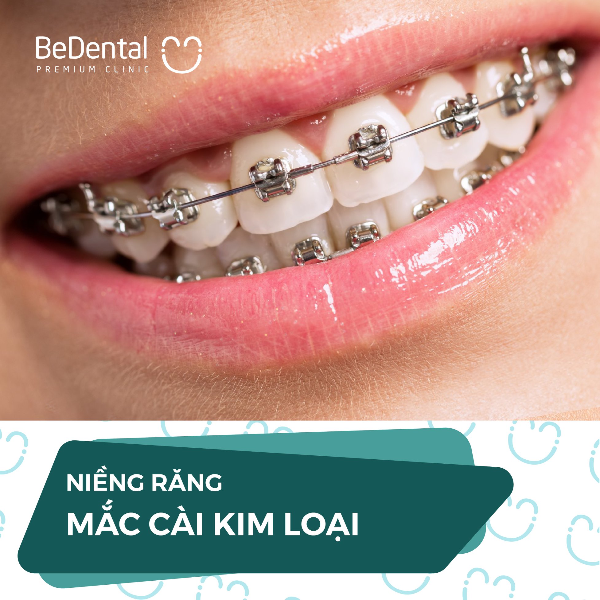 Voucher Niềng răng - Nha khoa BeDental - 5 chi nhánh