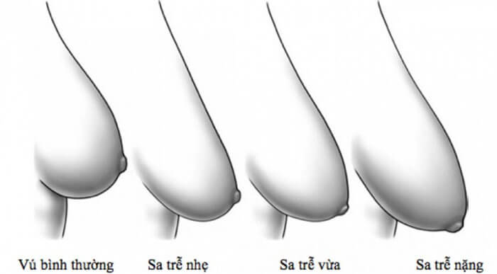 Cứ 100 người thì có 37 người bị ngực chảy xệ sau sinh