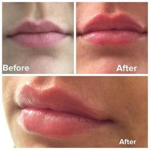 Gel dưỡng môi Image Ormedic Balancing Lip Enhancement Complex