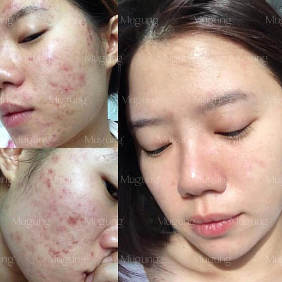 Bộ chăm sóc da mụn Mugung giúp sạch mụn,hết thâm mờ sẹo hiệu quả Serum Acne Treatment và Kem dưỡng da phục hồi không bong da bí quyết sạch bay mụn thâm,mụn bọc,mụn trứng cá, dành cho mọi loại da 15ml và 15gram