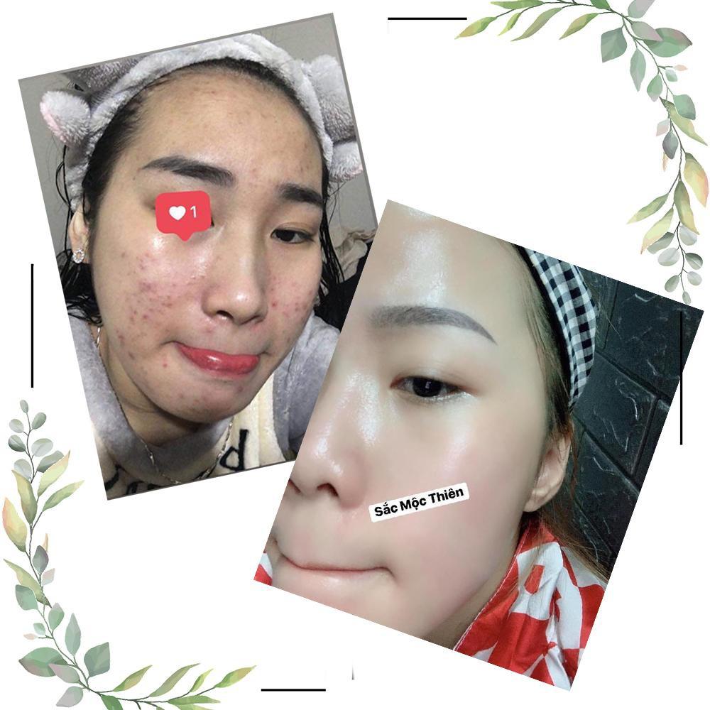 Bộ 3 Sản Phẩm Cải Thiện Mụn Siêu Tốc Sắc Mộc Thiên 30ml + 50gr + 100gr