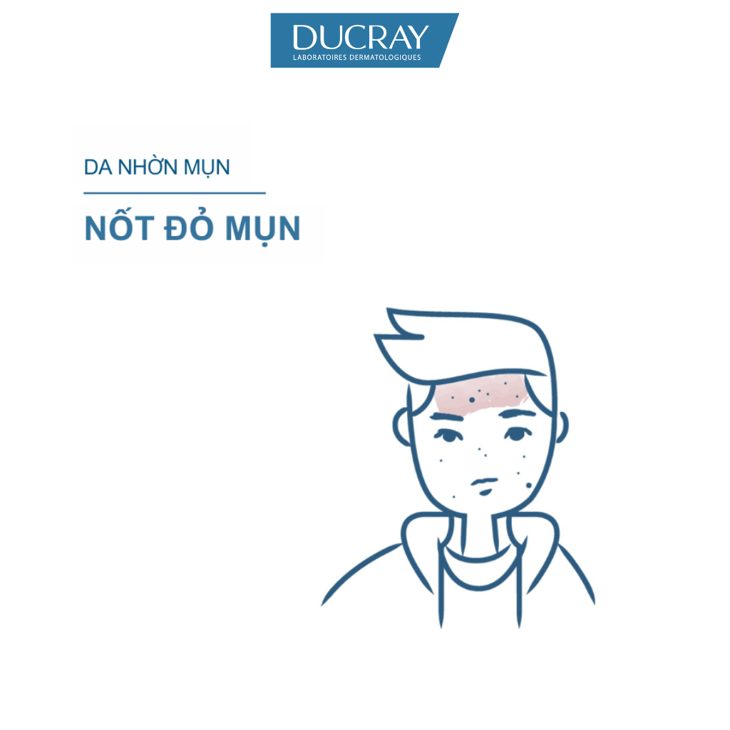 Kem ngừa mụn viêm &amp; thâm chuyên biệt dành cho da nhờn, tổn thương Ducray Keracnyl PP+ Anti-Blemish Cream 30ml