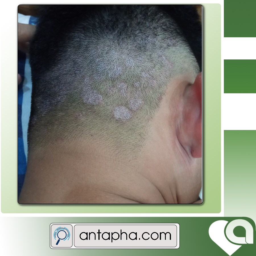 Dầu Gội TRINADA  hỗ trợ điều trị nấm da đầu, gàu ngứa ANTAPHA