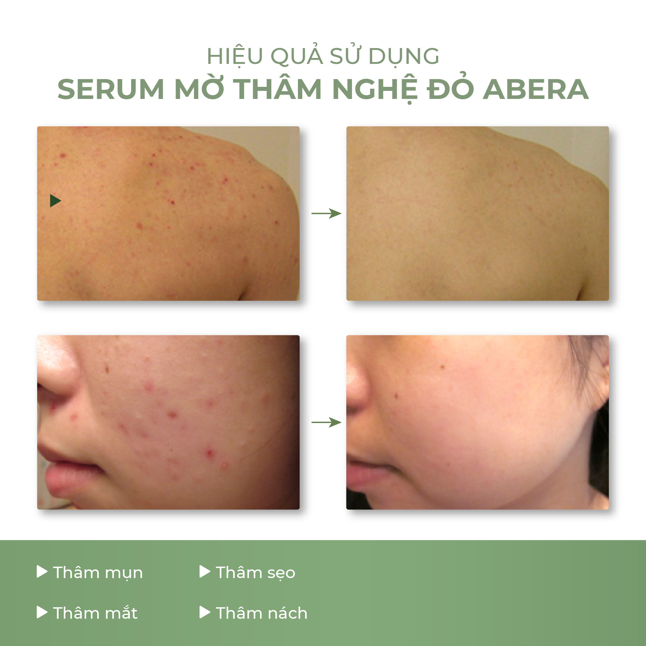 [Combo 2] Serum Nghệ Đỏ Nano Abera - 15ML Làm Mờ Thâm Mụn, Thâm Quầng Mắt , Tinh Chất Dưỡng Trắng Da