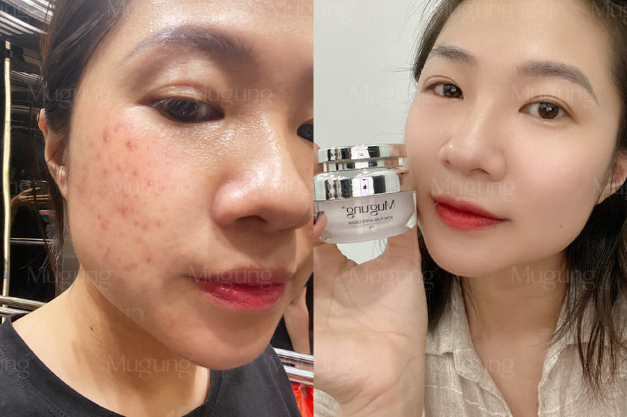Kem dưỡng da Mugung Pure White Acne Cream chuyên dưỡng da giảm mụn,phục hồi và dưỡng trắng da,se khít chân lông xóa vết thâm mụn công thức độc quyền