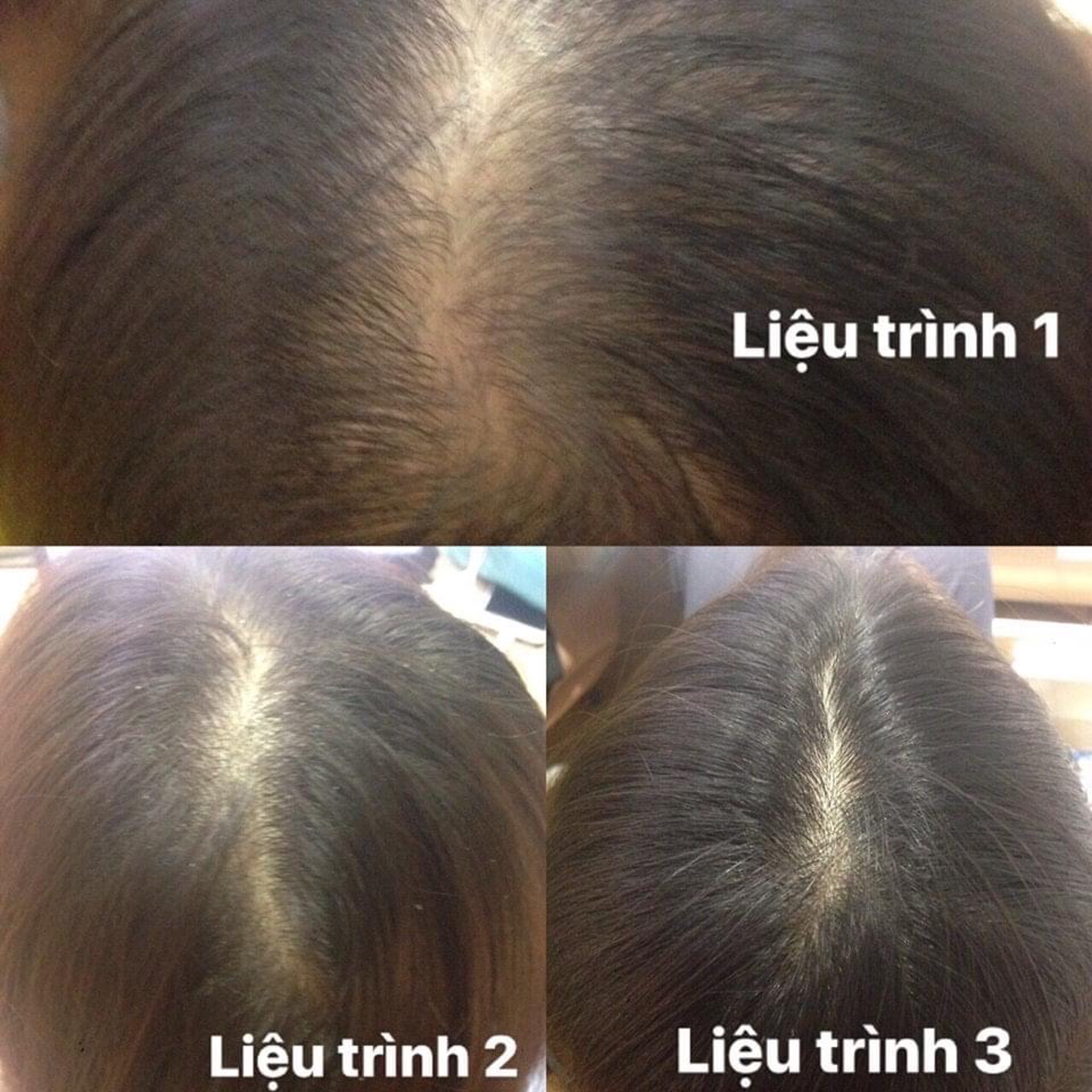 Combo set dầu gội, tinh chất Alika for Women kích thích mọc tóc, chắc khỏe