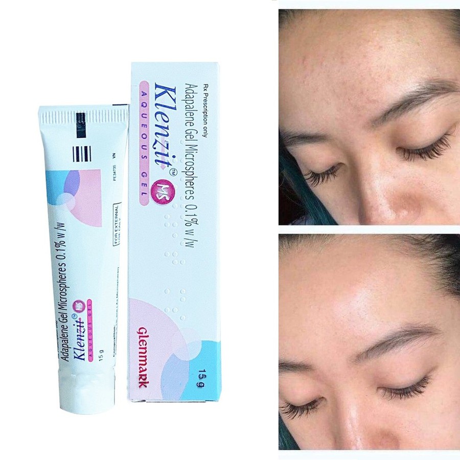 Gel Klenzit Ms giảm mụn trứng cá và mụn ẩn, thâm mụn (Tuýp 15g)