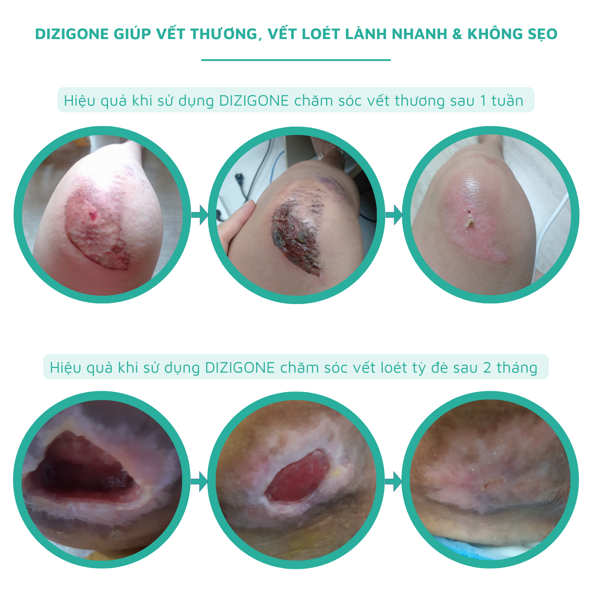 Xịt kháng khuẩn DIZIGONE chăm sóc tổn thương lành nhanh, không đau xót, tái tạo da, ngăn ngừa sẹo