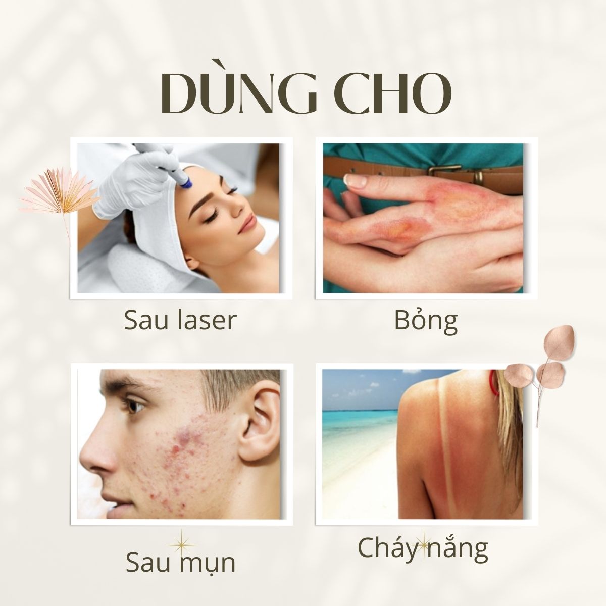 Gel thoa bỏng Burnova Plus tái tạo da sau bỏng, sau laser, làm lành vết thương, vết thương mụn 25g