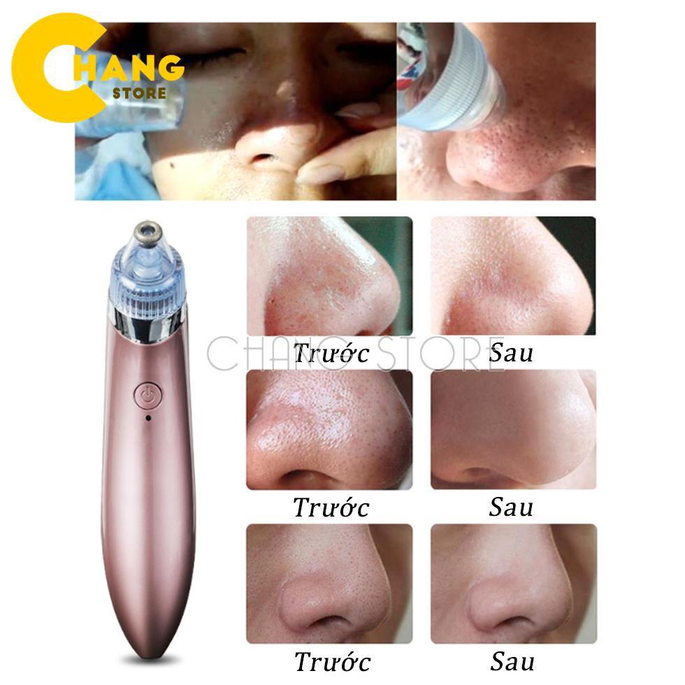 Máy Hút Mụn Beauty Skin Hút Mụn Cho Bạn Làn Da Sạch