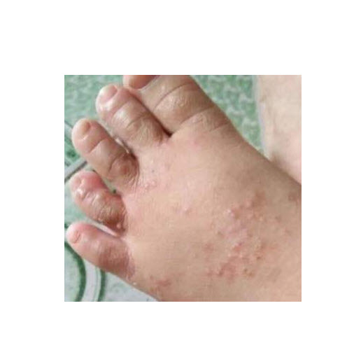 Thảo dược bôi nấm ngứa, tổ đỉa, hắc lào, lang ben, vảy nến, á sừng, zona các vấn đề về da_1 hộp 20 gói