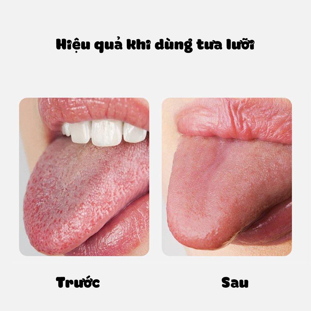 Dụng cụ tưa lưỡi chuyên dụng, cạo vệ sinh lưỡi, giúp giảm hôi miệng, làm sạch vi khuẩn, ngăn ngừa các bệnh về răng miệng