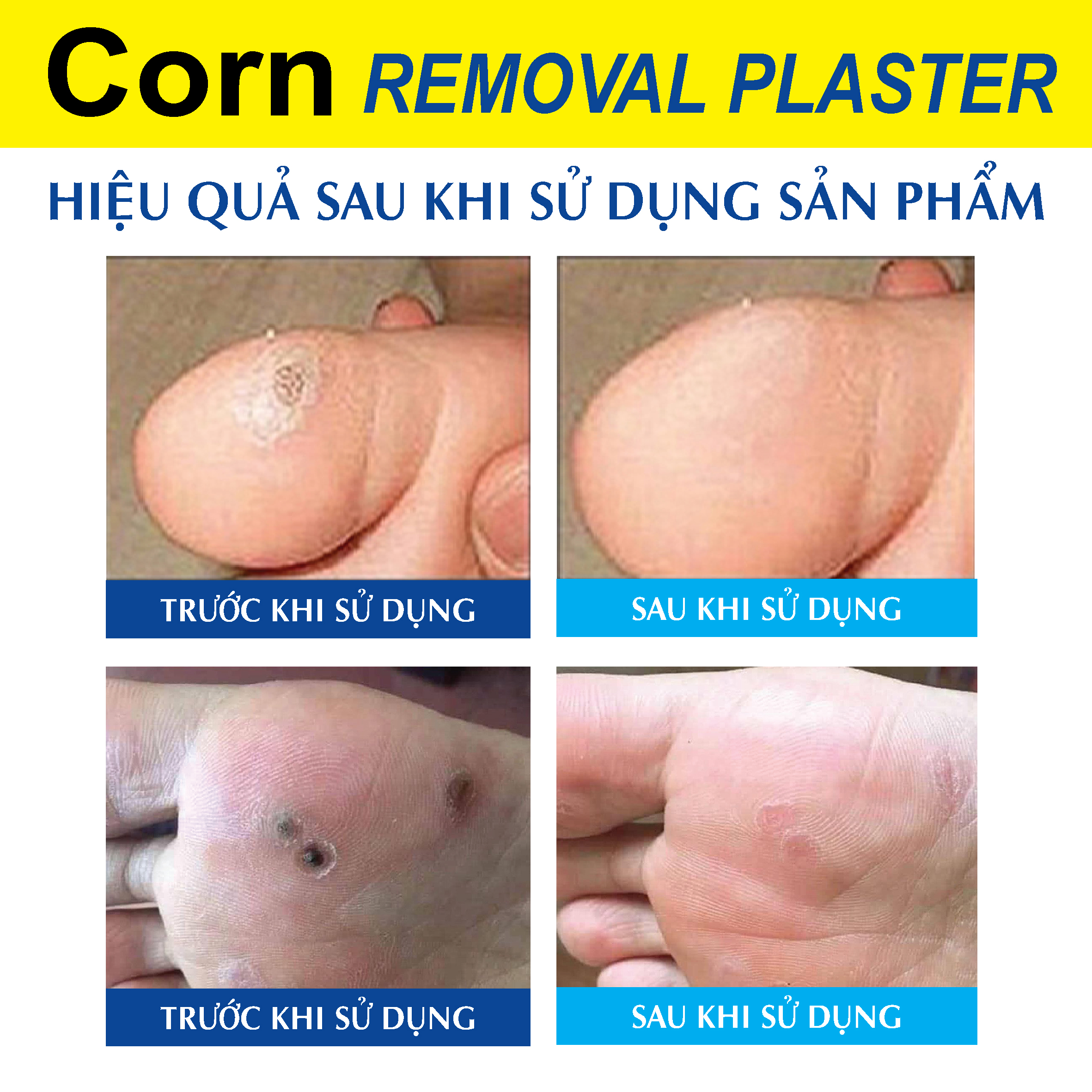 Combo 2 Hộp Miếng Dán Mụn Cóc Loại Bỏ Mụn Cóc Tại Nhà An Toàn Hiệu Quả - Hộp 6 miếng