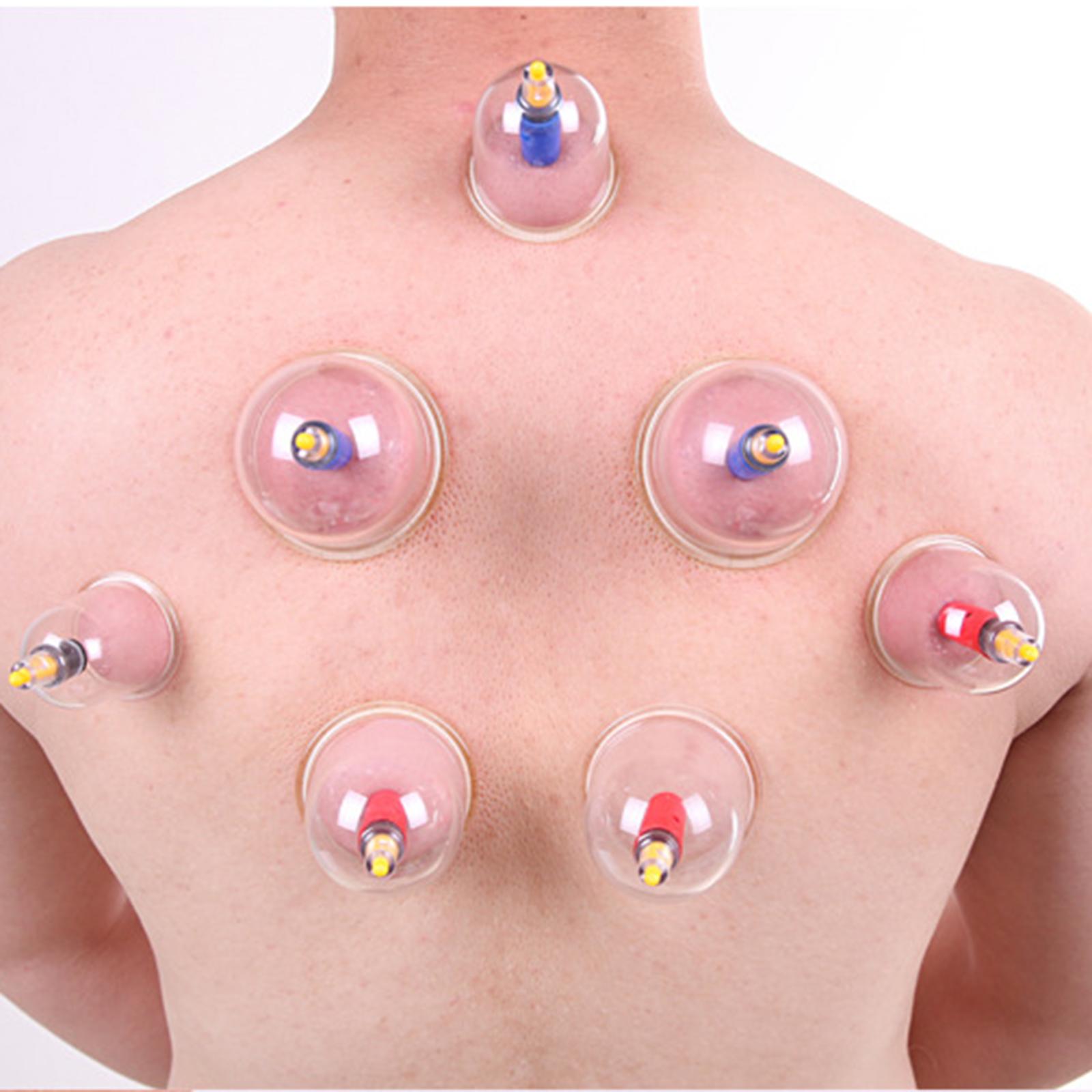 Bộ 24 Ly giác hơi toàn thân nhiều kích cỡ