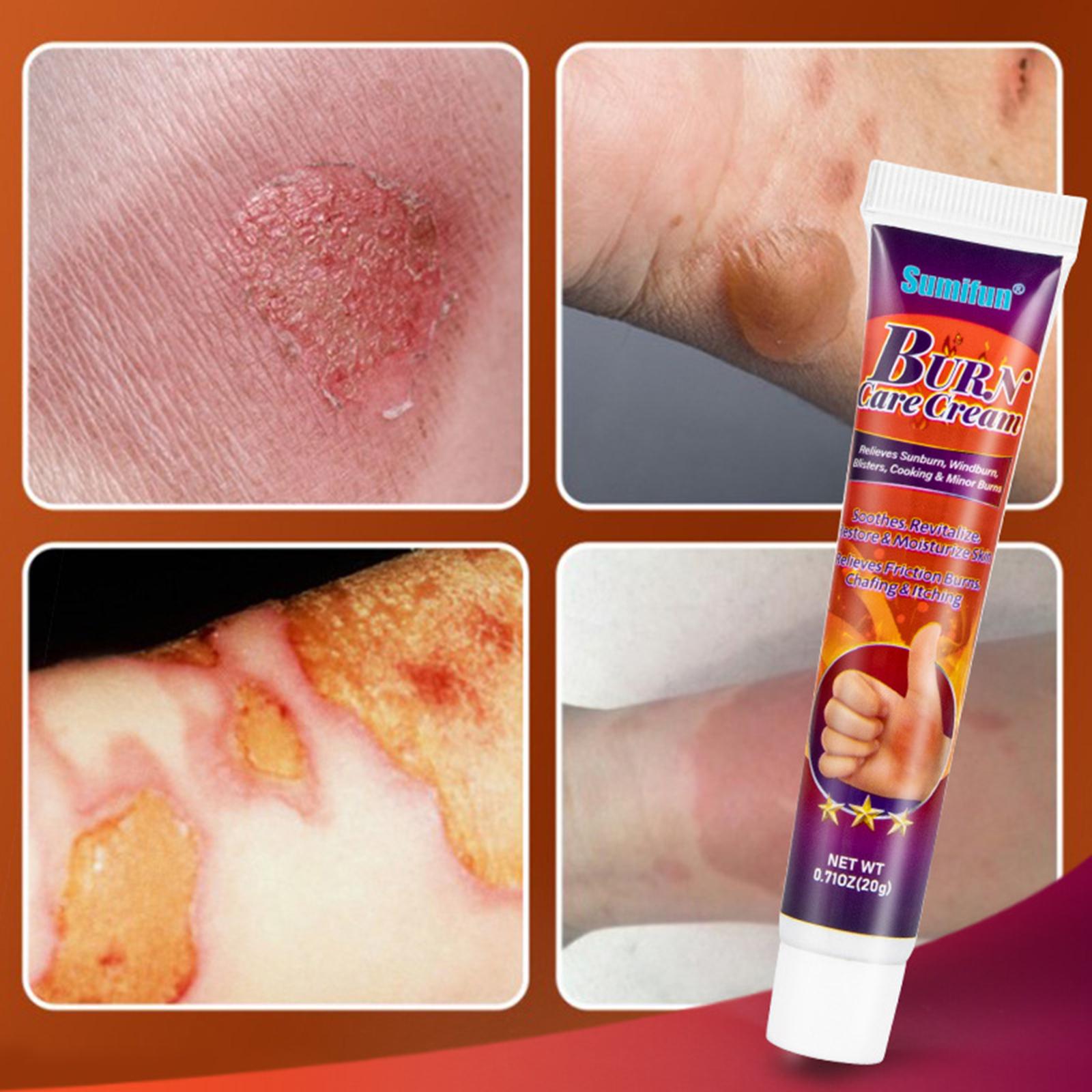 Sumifun 20g Skin Burn Care Cream Relieve Sunburn Windburn Blisters Cooking Burns Healing Care Moisturize Skin