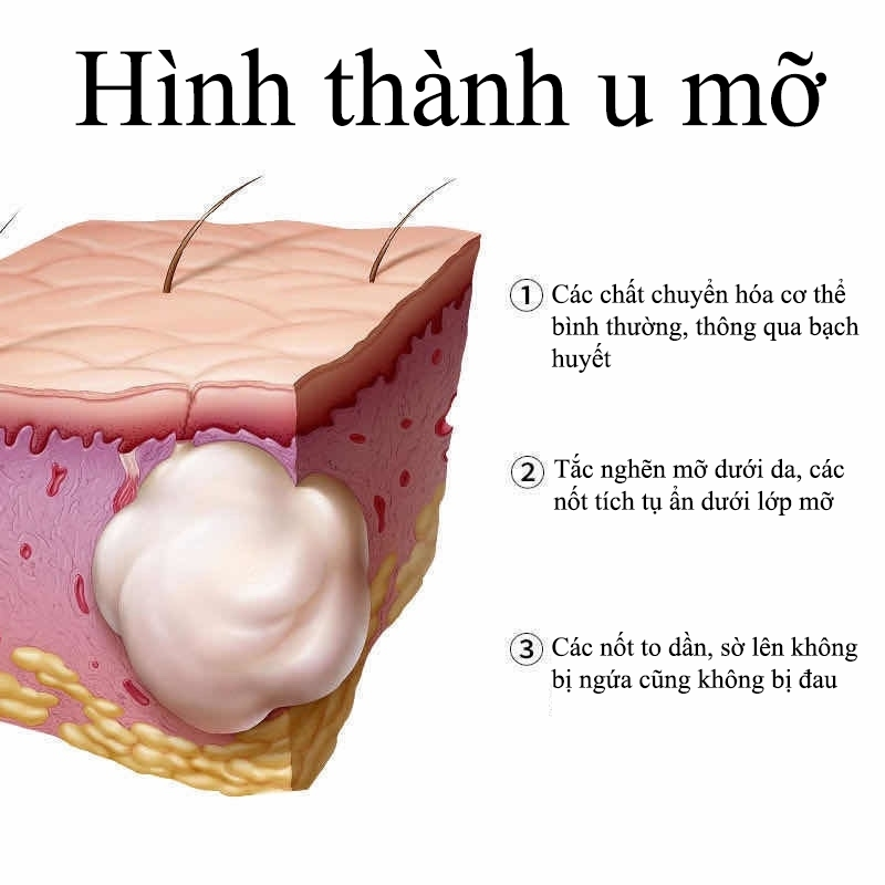 Kem bôi u bướu mỡ, thành phần thảo dược tự nhiên, an toàn tuyệt đối