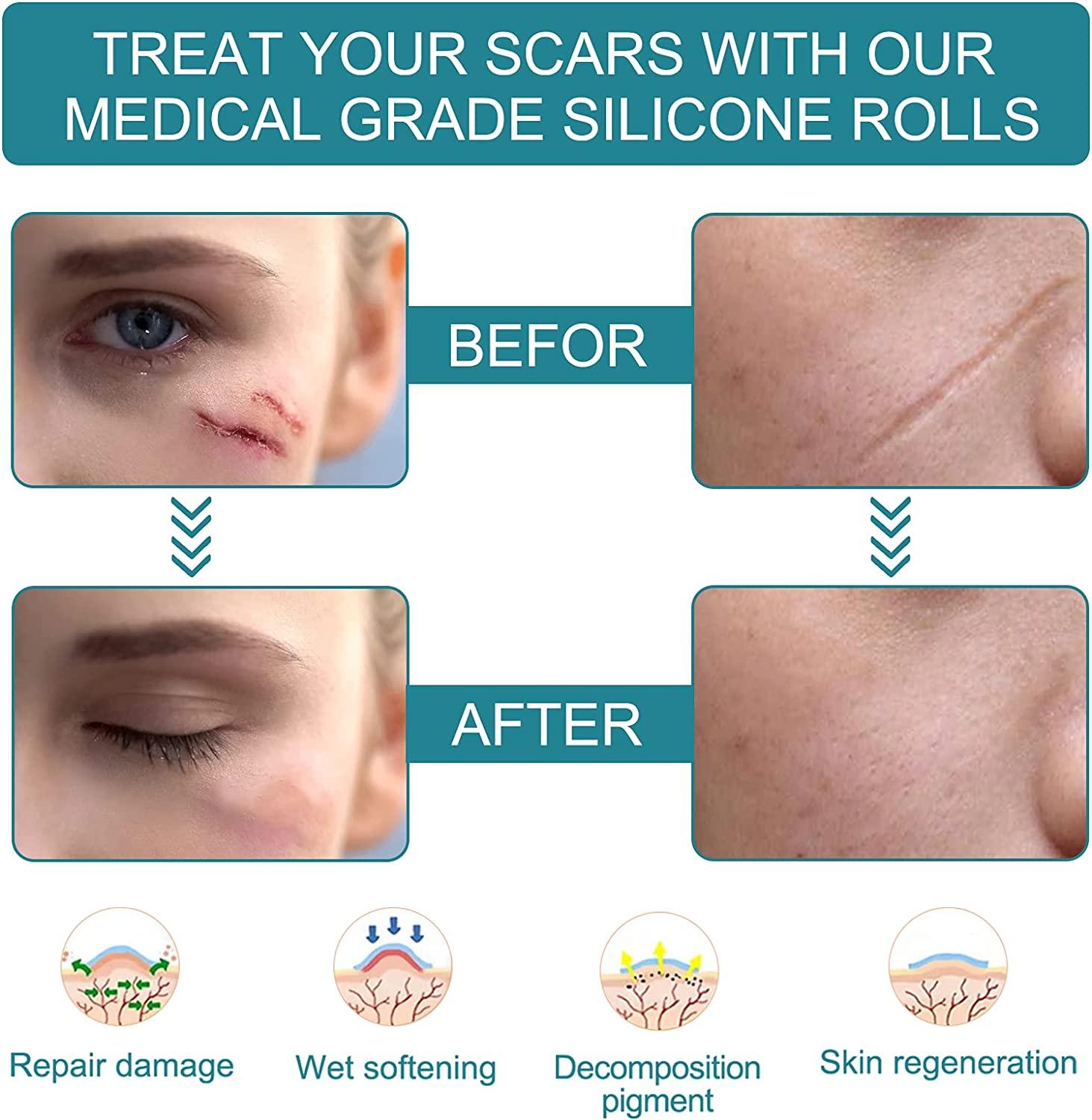 Silicone Scar Dressing để lá từ vết sẹo silicone cho sinh mổ, phẫu thuật, bỏng, sẹo, sẹo do mụn trứng cá