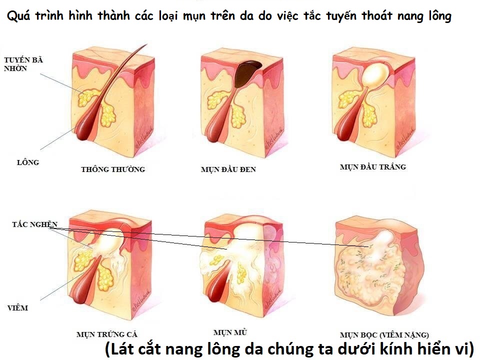 Kem đánh bay mụn thịt, mụn cơm, mụn quanh mắt, nốt ruồi,... thành phần thảo dược thiên nhiên 100%_HBESTY