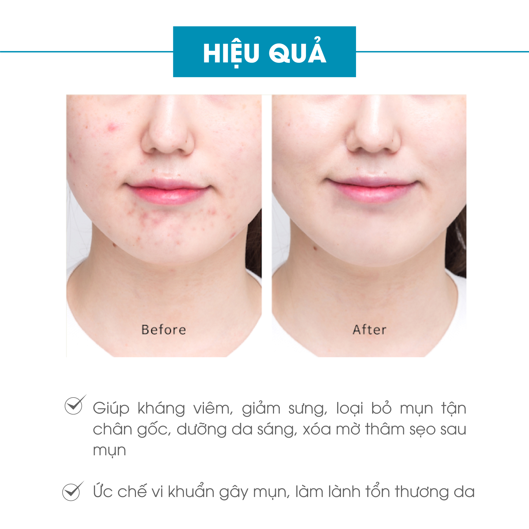 Bộ ngừa mụn da mặt Truesky Premium gồm 1 serum ngừa mụn tràm trà 20ml + 1 sữa rửa mặt tạo bọt than hoạt tính 60ml